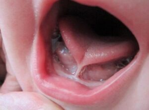 Fisioterapia en frenillo lingual corto
