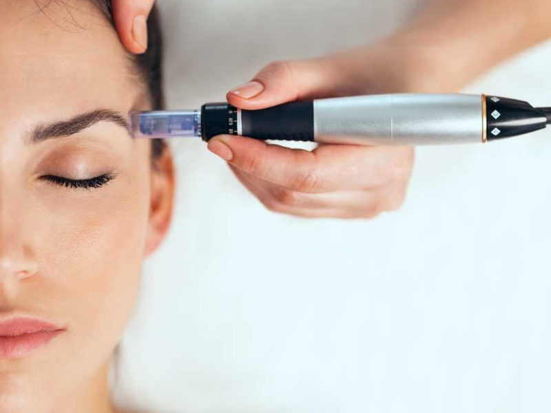 Microneedling Tavernes de la Valldigna