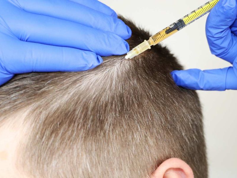 Mesoterapia capilar en Tavernes de la Valldigna